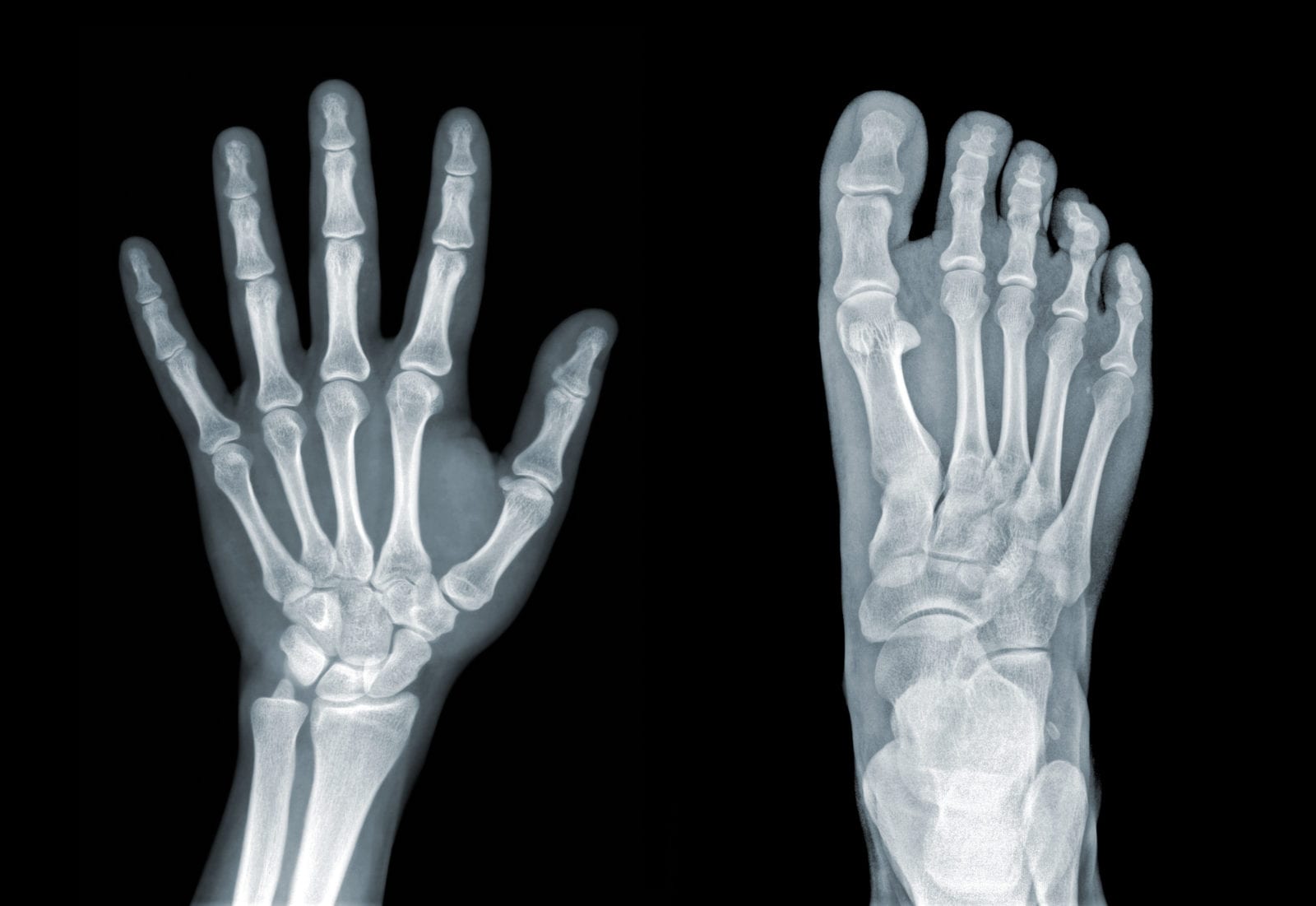 Does Medicare Cover Dexa Scan