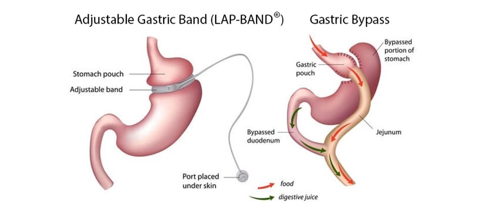 can-i-get-lap-band-surgery-on-medicare-medicaretalk