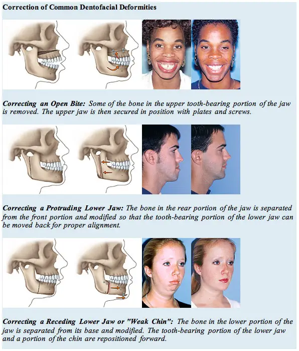 does-medicare-cover-jaw-surgery-medicaretalk